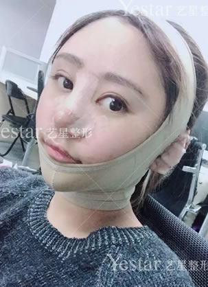 女神自愿分享在西安艺星做面部吸脂和眼鼻综合整形手术全纪录