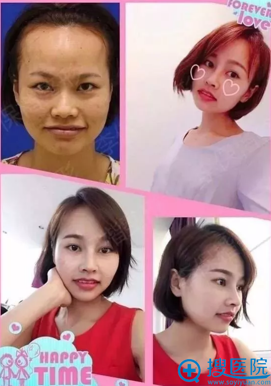 李保锴隆鼻案例照片 李保锴隆鼻案例照片