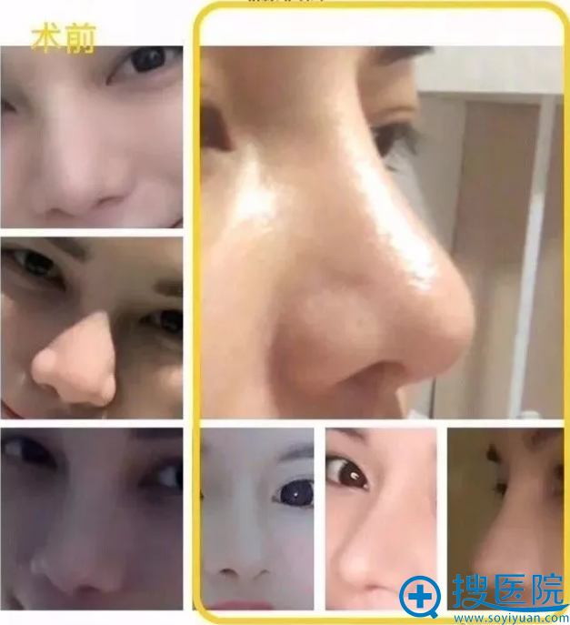 李保锴做鼻子做得好 李保锴做鼻子做得好