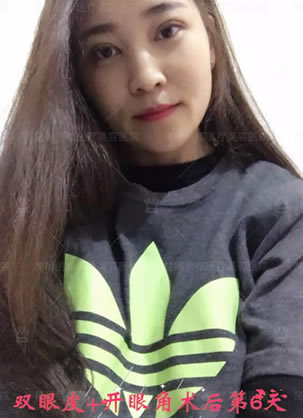 年前做双眼皮还得及吗?昆明丽都真人案例6天恢复效果及小妙招