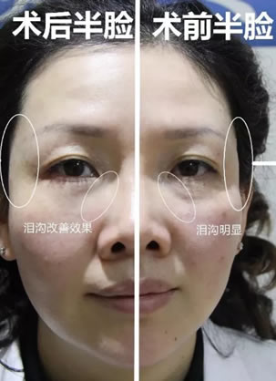 50岁贵阳美莱美女牙医分享黄剑美注射爱贝芙面部抗衰蜕变全过程