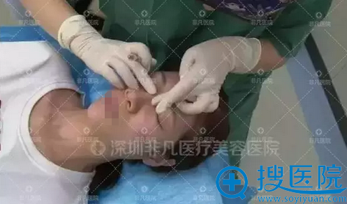 玻尿酸隆鼻需要医师揉捏定型 玻尿酸隆鼻需要医师揉捏定型
