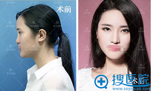 深圳非凡整形美容医院膨体隆鼻术后对比照 深圳非凡整形美容医院膨体隆鼻术后对比照