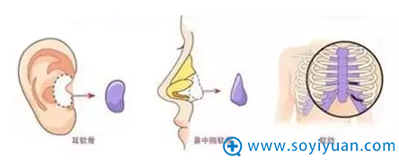 自体软骨材料来源 自体软骨材料来源