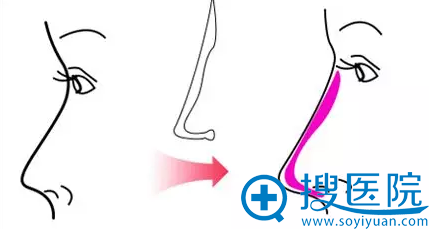 深圳非凡假体、玻尿酸、自体软骨隆鼻案例集合,哪种才是你的菜