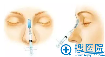 玻尿酸隆鼻手术示意图 玻尿酸隆鼻手术示意图