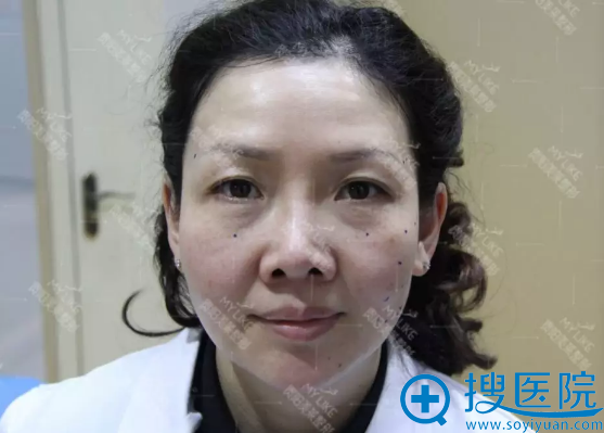 需要注射玻尿酸填充的部位标记 需要注射玻尿酸填充的部位标记