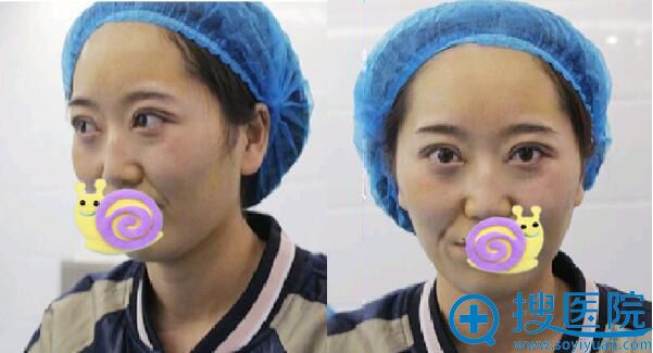 刚手术完 眼睛瞬间变大 刚手术完 眼睛瞬间变大