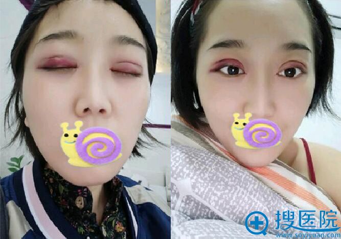 术后第二天 眼睛有点肿 术后第二天 眼睛有点肿