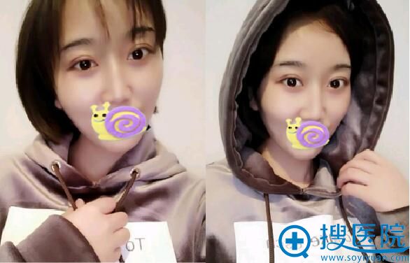术后20天, 感觉恢复的不错 术后20天, 感觉恢复的不错