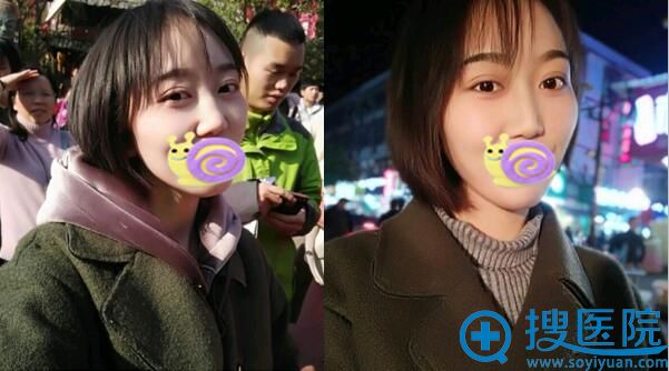 术后一个半月 像不像变个人 术后一个半月 像不像变个人