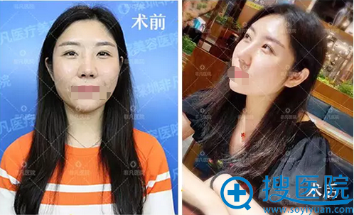 假体隆鼻+耳软骨垫鼻尖术后对比照 假体隆鼻+耳软骨垫鼻尖术后对比照