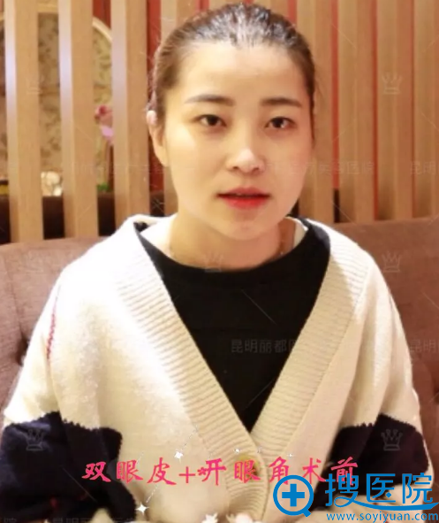 做双眼皮和开眼角手术前照片 做双眼皮和开眼角手术前照片