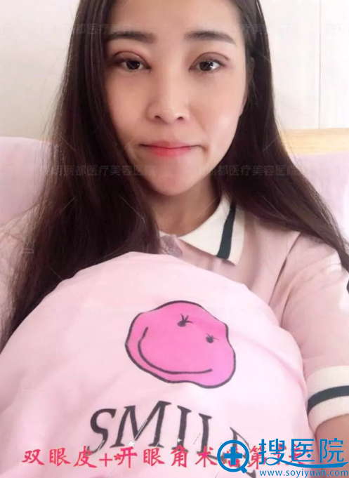 <!--<i data=20240710 data-id=14470></i>-->割双眼皮手术第1天恢复照 <!--<i data=20240710 data-id=14470></i>-->割双眼皮手术第1天恢复照