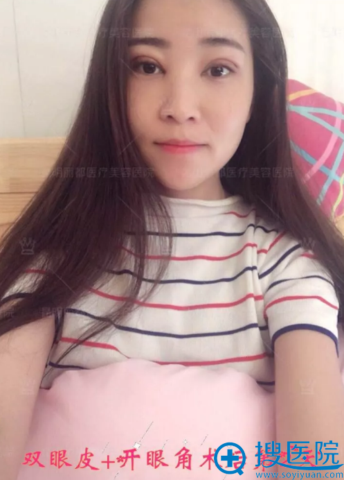 双眼皮+开眼角手术第2天恢复图 双眼皮+开眼角手术第2天恢复图