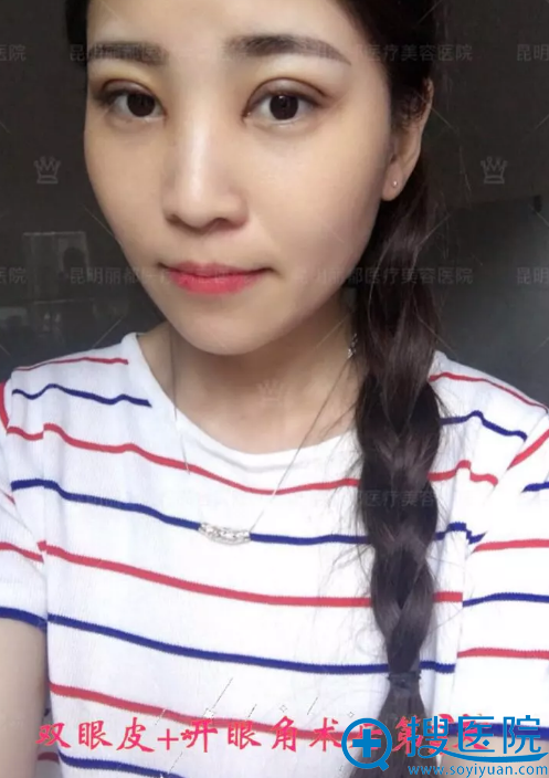 做双眼皮手术第3天能恢复啥样 做双眼皮手术第3天能恢复啥样