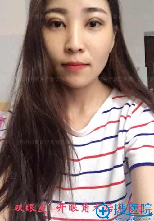 全切双眼皮手术第4天能水肿吗 全切双眼皮手术第4天能水肿吗