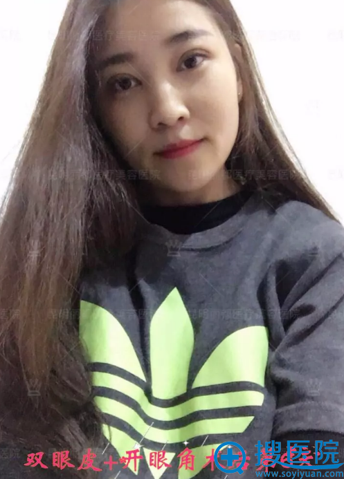 <!--<i data=20240710 data-id=14470></i>-->双眼皮6天恢复自然效果 <!--<i data=20240710 data-id=14470></i>-->双眼皮6天恢复自然效果