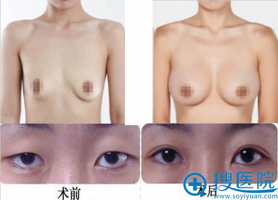 衡阳雅美双眼皮和假体隆胸案例 衡阳雅美双眼皮和假体隆胸案例