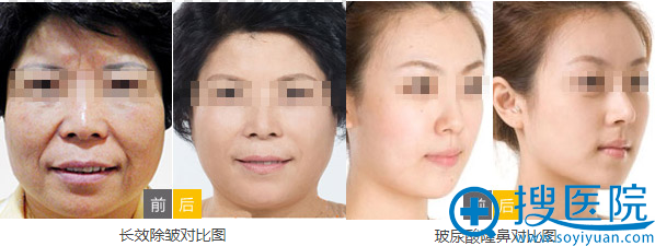 济南美思慕医院面部除皱和玻尿酸隆鼻案例 济南美思慕医院面部除皱和玻尿酸隆鼻案例