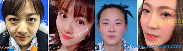 济南美思慕切开双眼皮前后对比效果 济南美思慕切开双眼皮前后对比效果