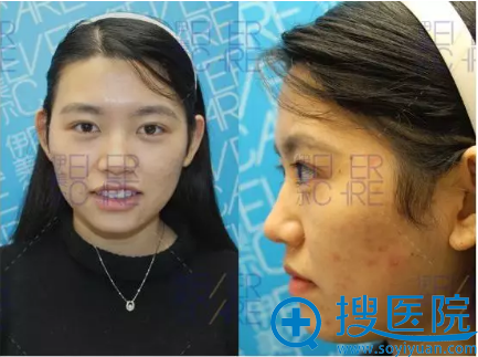 已有初老症的我找沈阳伊美尔郎劲松院长做了自体脂肪全脸填充