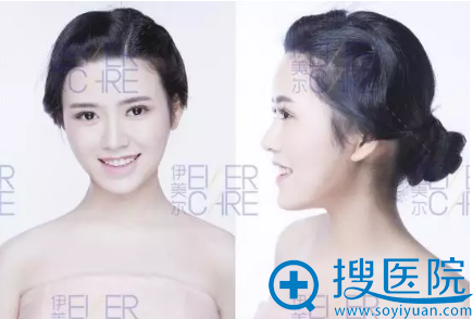 脂肪填充术后照片 脂肪填充术后照片