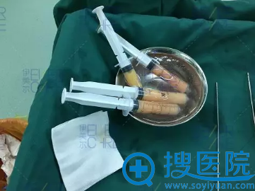 抽取出来的脂肪 抽取出来的脂肪