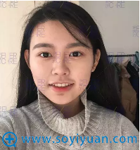 自体脂肪填充7天自拍 自体脂肪填充7天自拍
