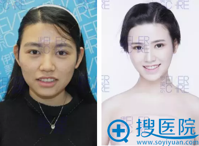 全脸脂肪填充对比照片 全脸脂肪填充对比照片