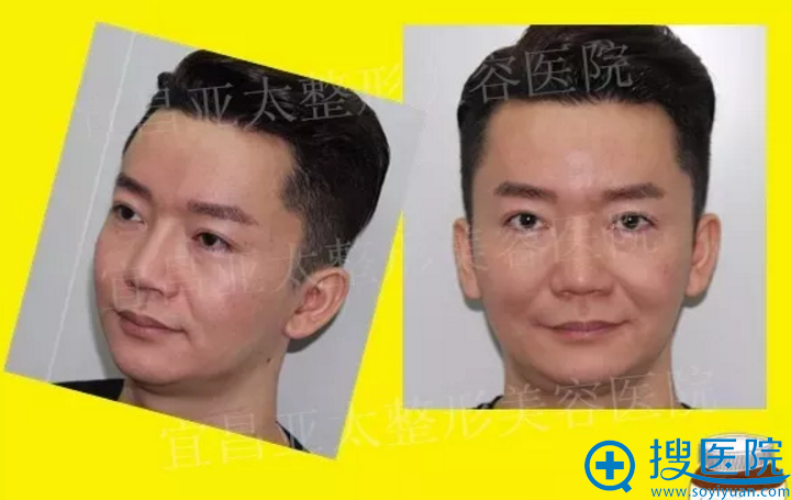 阿成做隆下巴手术前的照片 阿成做隆下巴手术前的照片