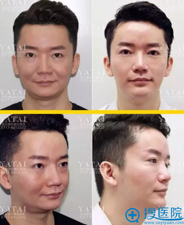 <!--<i data=20240710 data-id=9828></i>-->阿成隆下巴前后对比图 <!--<i data=20240710 data-id=9828></i>-->阿成隆下巴前后对比图