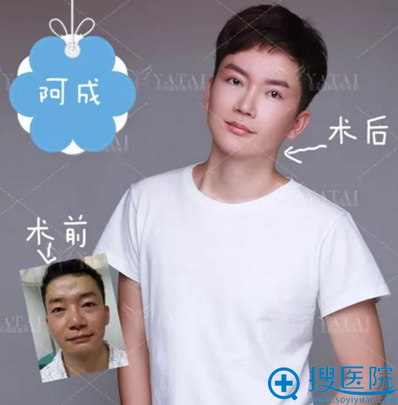 <!--<i data=20240710 data-id=9828></i>-->男士垫下巴员工案例 <!--<i data=20240710 data-id=9828></i>-->男士垫下巴员工案例