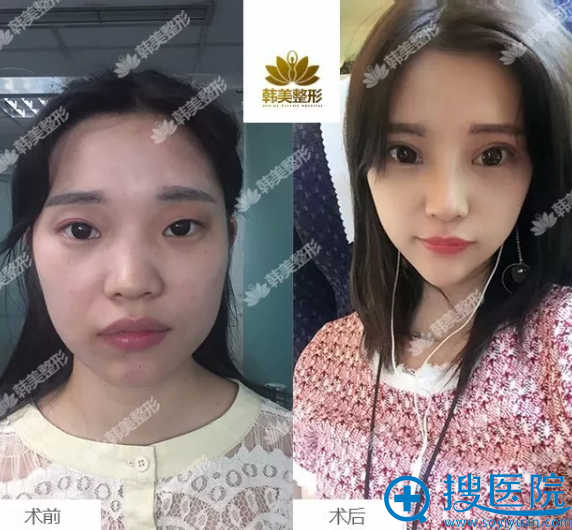 汉中韩美双眼皮和开眼角案例 汉中韩美双眼皮和开眼角案例