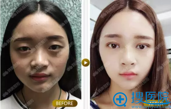 汉中韩美常双模扇形双眼皮案例 汉中韩美常双模扇形双眼皮案例