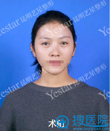 昆明yestar刘哲延做鼻子好吗?鼻综合术后15天对比照看分晓