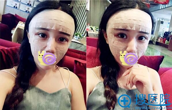 合肥崔劲松自体脂肪面部填充术后 合肥崔劲松自体脂肪面部填充术后