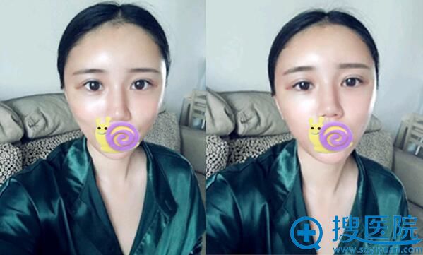 合肥自体脂肪填充哪家好?合肥崔劲松自体脂肪面部填充案例 合肥自体脂肪填充哪家好?合肥崔劲松自体脂肪面部填充案例