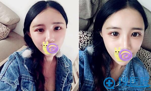 合肥崔劲松自体脂肪丰面术后恢复效果图 合肥崔劲松自体脂肪丰面术后恢复效果图