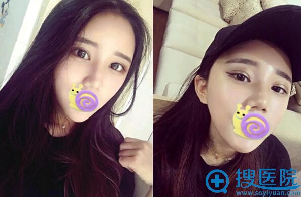 合肥崔劲松自体脂肪面部填充术后19天恢复效果图 合肥崔劲松自体脂肪面部填充术后19天恢复效果图