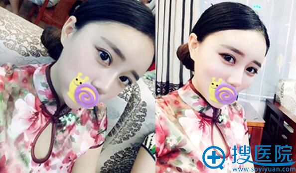 合肥崔劲松脂肪填充效果怎么样?案例术后恢复效果 合肥崔劲松脂肪填充效果怎么样?案例术后恢复效果