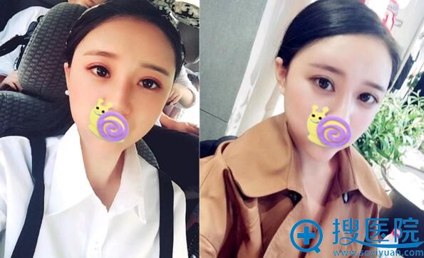 合肥崔劲松脂肪填充全脸术后恢复效果图 合肥崔劲松脂肪填充全脸术后恢复效果图
