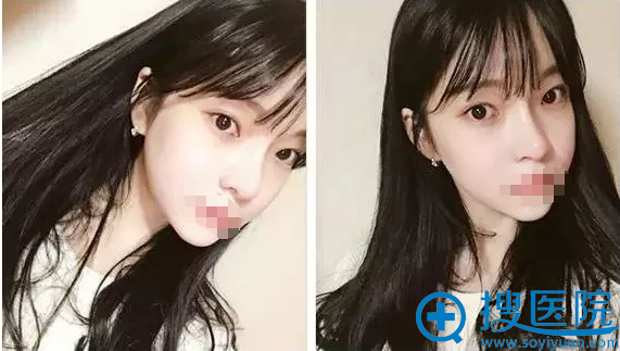 ����֬������沿��2���»ָ���Ȼ