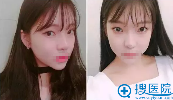 �Ͼ�֬�����ȫ�沿4����Ч��