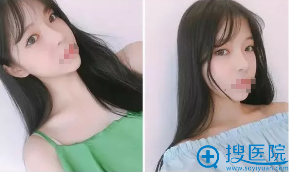 ����֬�����沿7���»ָ�������