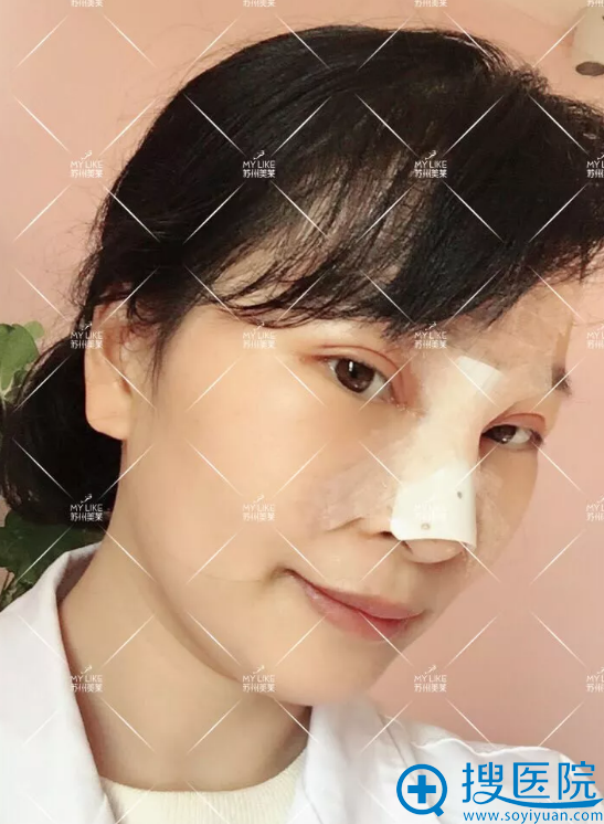做假体隆鼻手术第3天恢复效果 做假体隆鼻手术第3天恢复效果