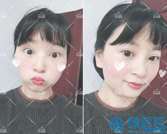 <!--<i data=20240710 data-id=13583></i>-->尹飞隆鼻手术15天恢复照 <!--<i data=20240710 data-id=13583></i>-->尹飞隆鼻手术15天恢复照