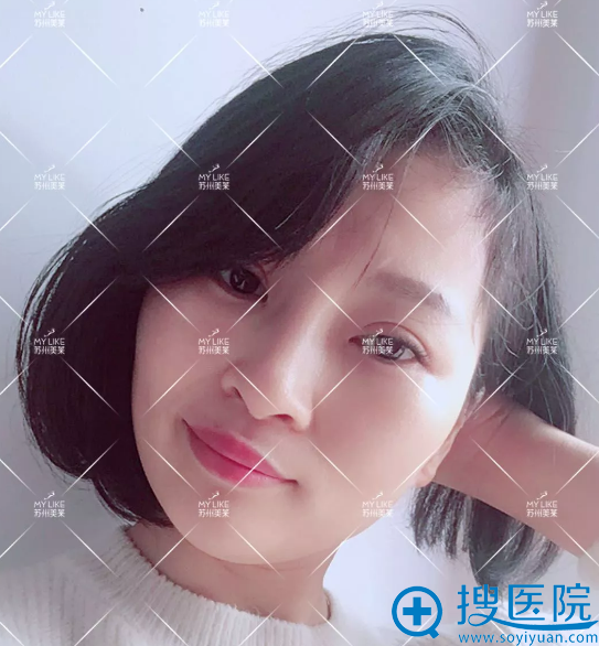 膨体隆鼻手术30天恢复效果怎么样 膨体隆鼻手术30天恢复效果怎么样