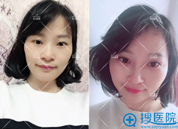 假体隆胸手术30天效果对比图 假体隆胸手术30天效果对比图
