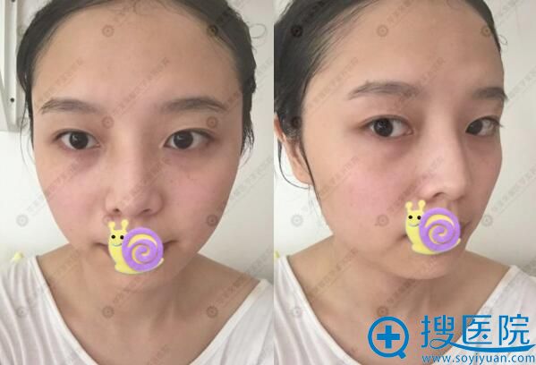 15天成自然 四川华美紫馨邱伟为我打造的急速纳米美眼真人案例